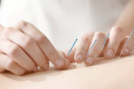 97801458-young-woman-undergoing-acupuncture-treatment-closeup.jpg